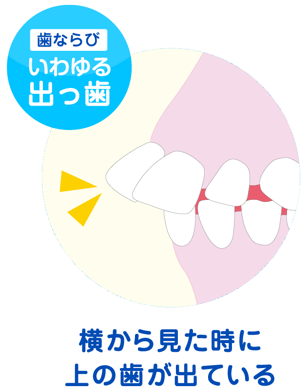 上顎前突のイメージ