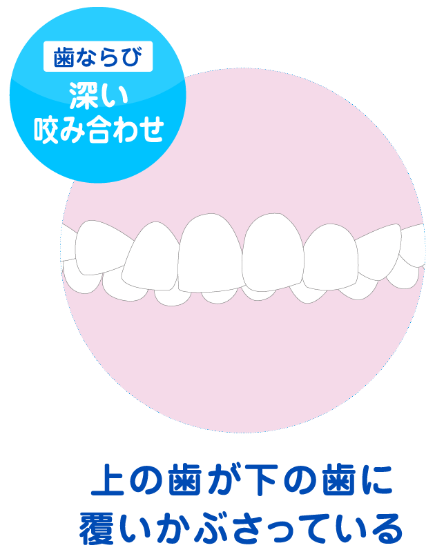 過蓋咬合のイメージ