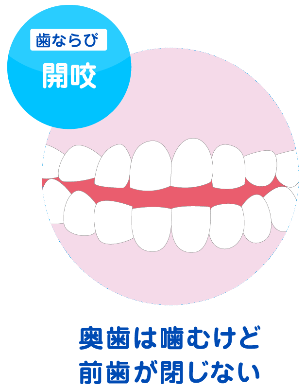 開咬のイメージ